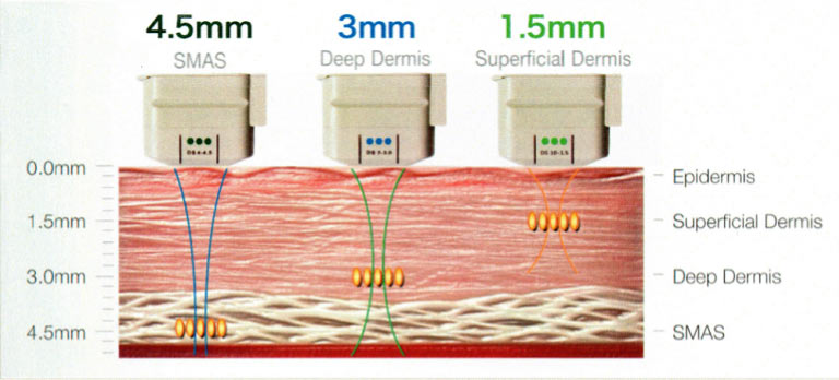 お顔の組織に合わせた３種類、4.5mm、3.0mm、のカートリッジで深度は3段階で調節可能です